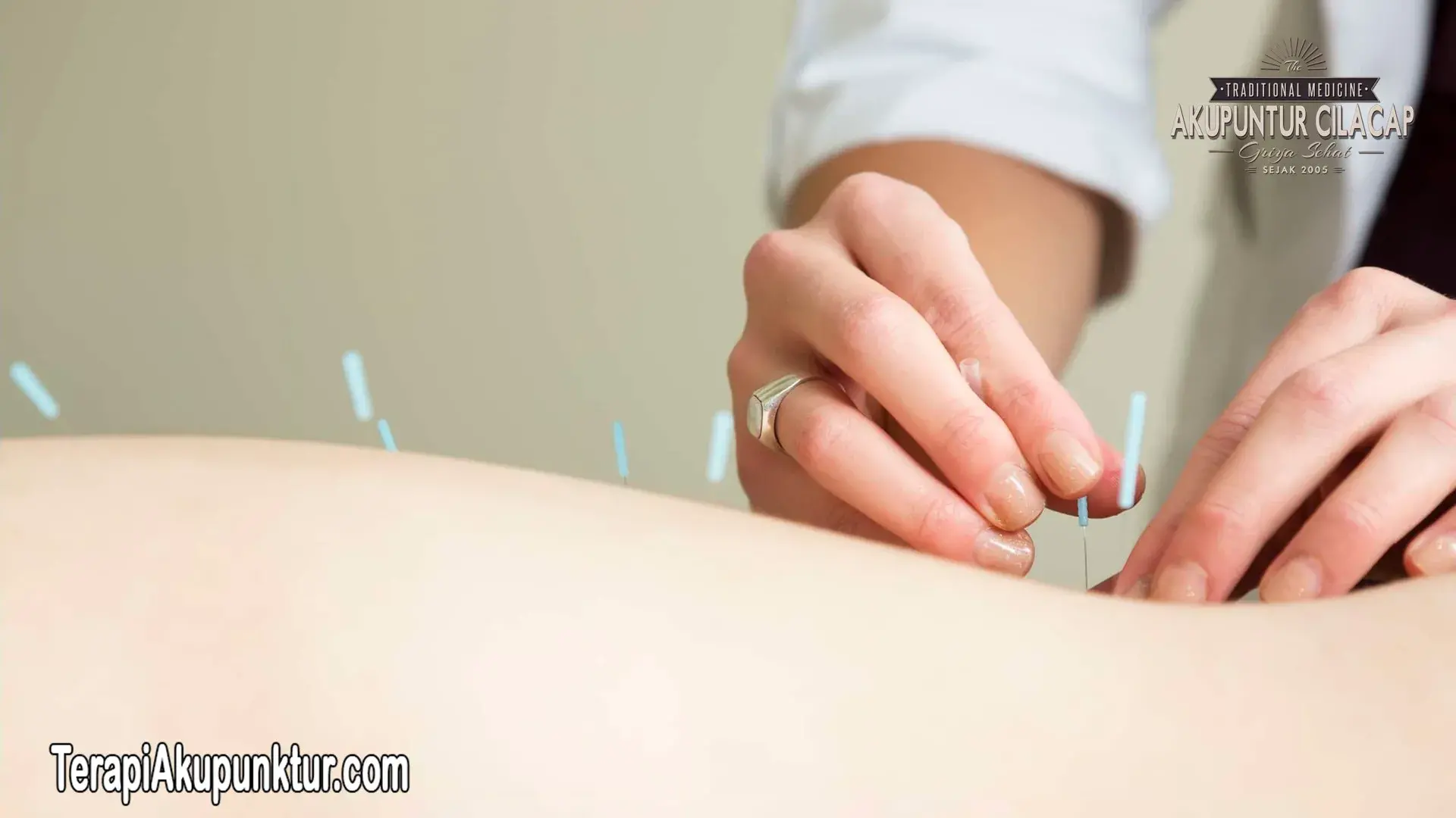 Akupunktur Untuk Kesemutan 4