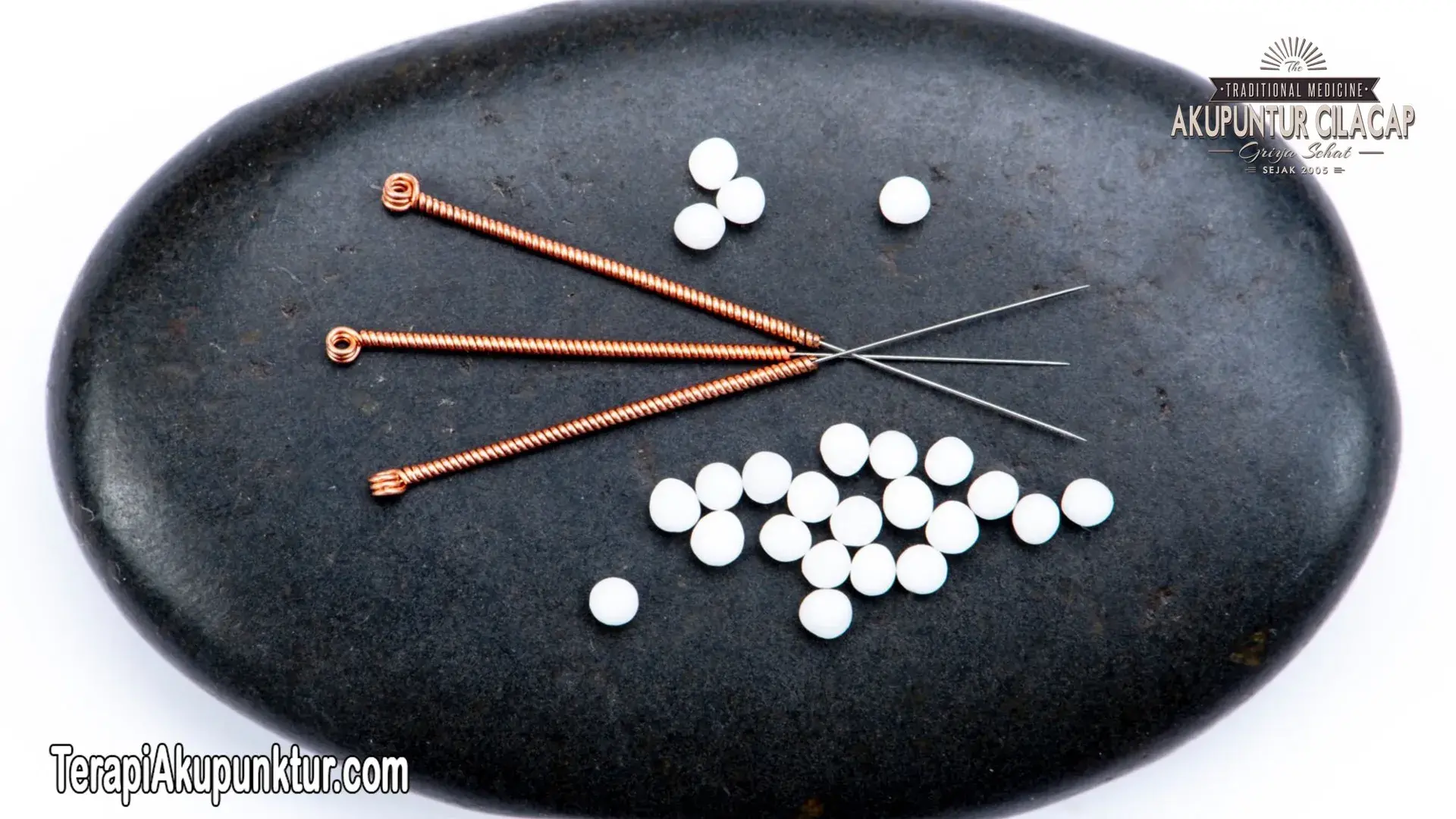 Akupunktur Untuk Kista