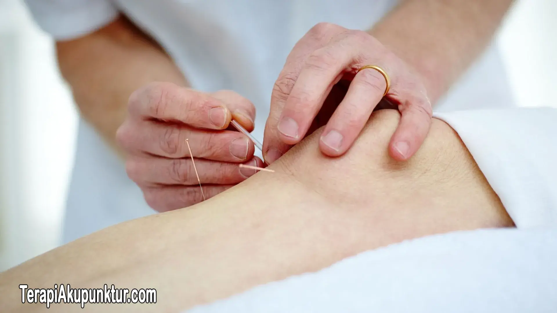 Akupunktur Untuk Migrain