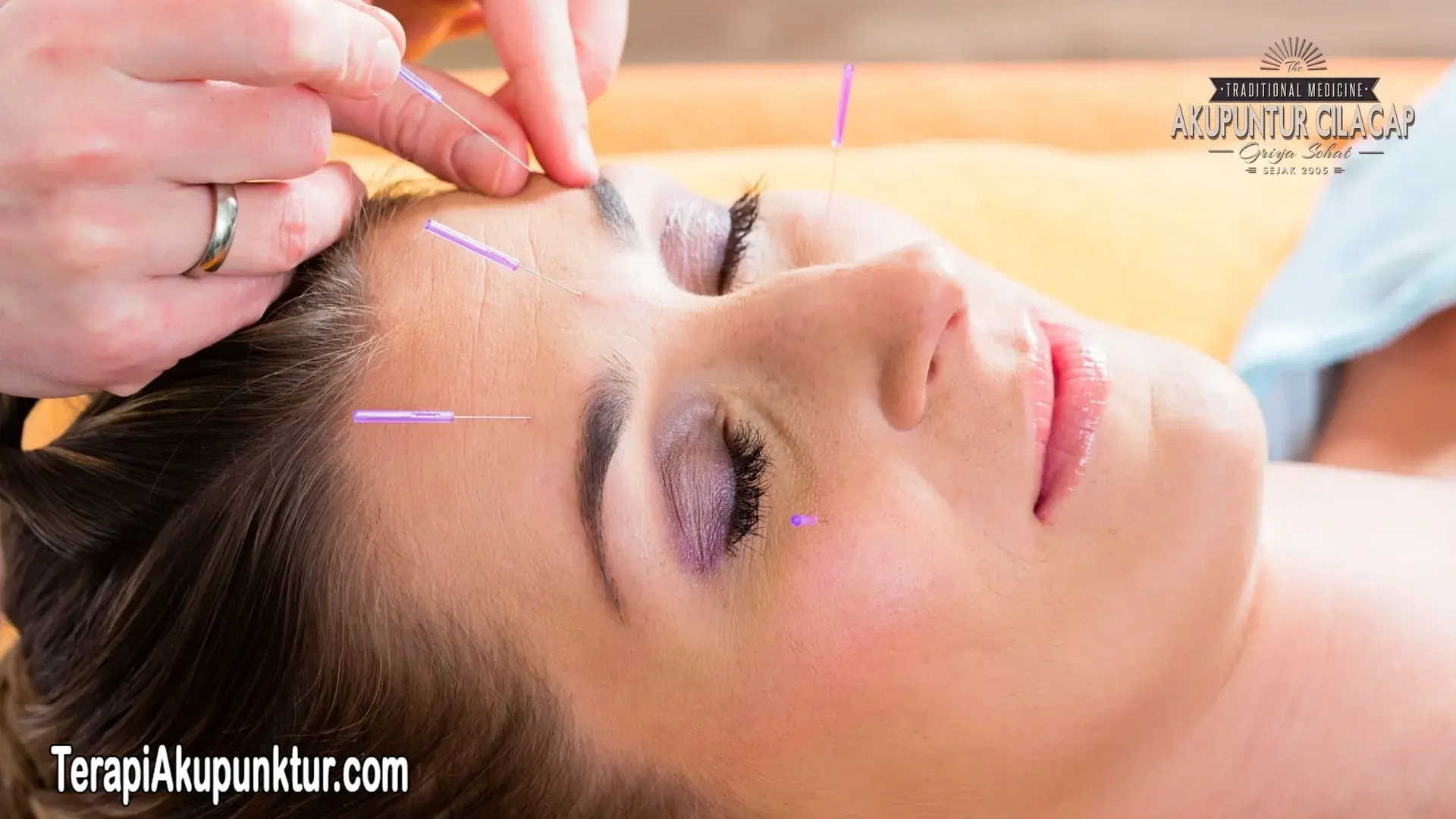 Akupunktur Untuk Migrain