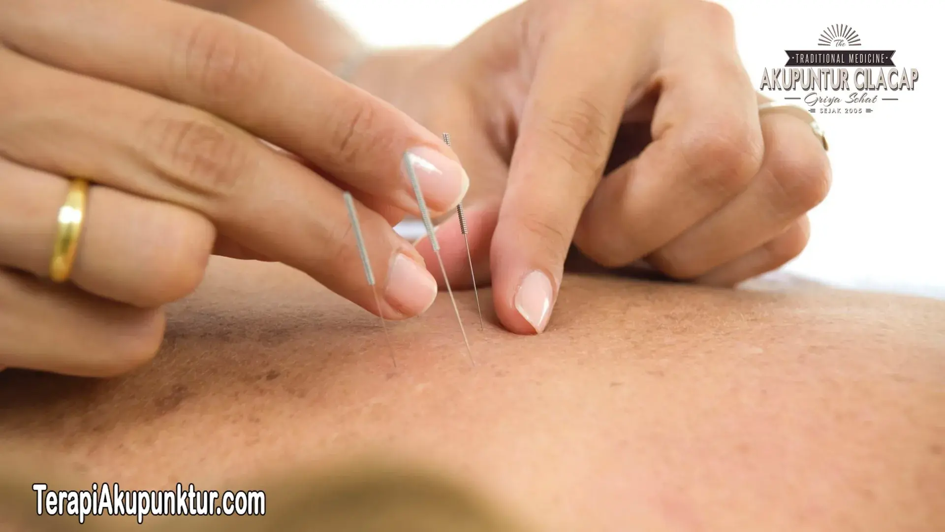 Akupunktur Untuk Saraf Kejepit