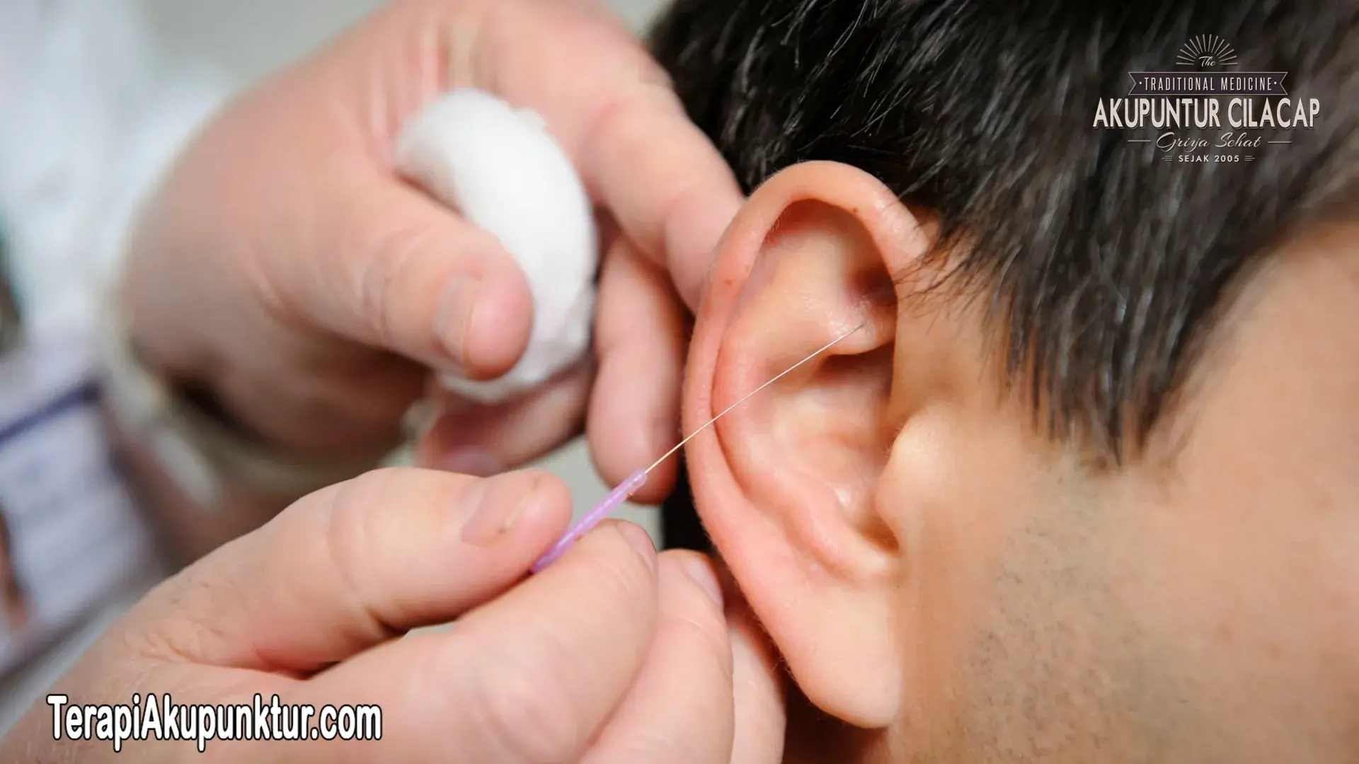 Durasi Pengobatan Akupunktur untuk Vertigo