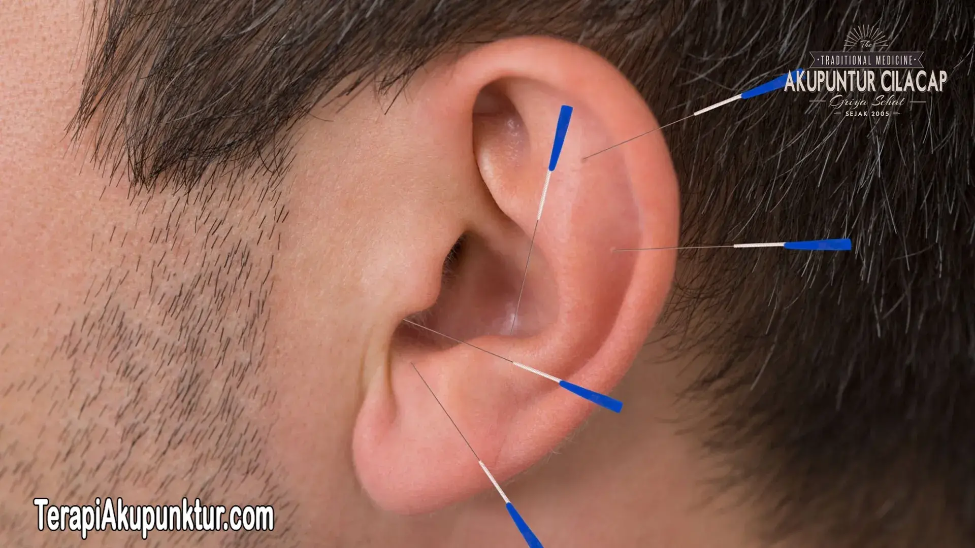 Manfaat Akupunktur untuk Vertigo