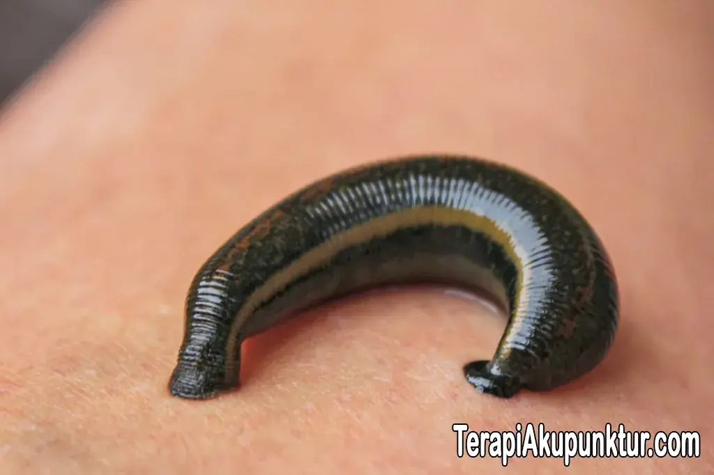 Mengurangi Peradangan dengan Terapi Lintah