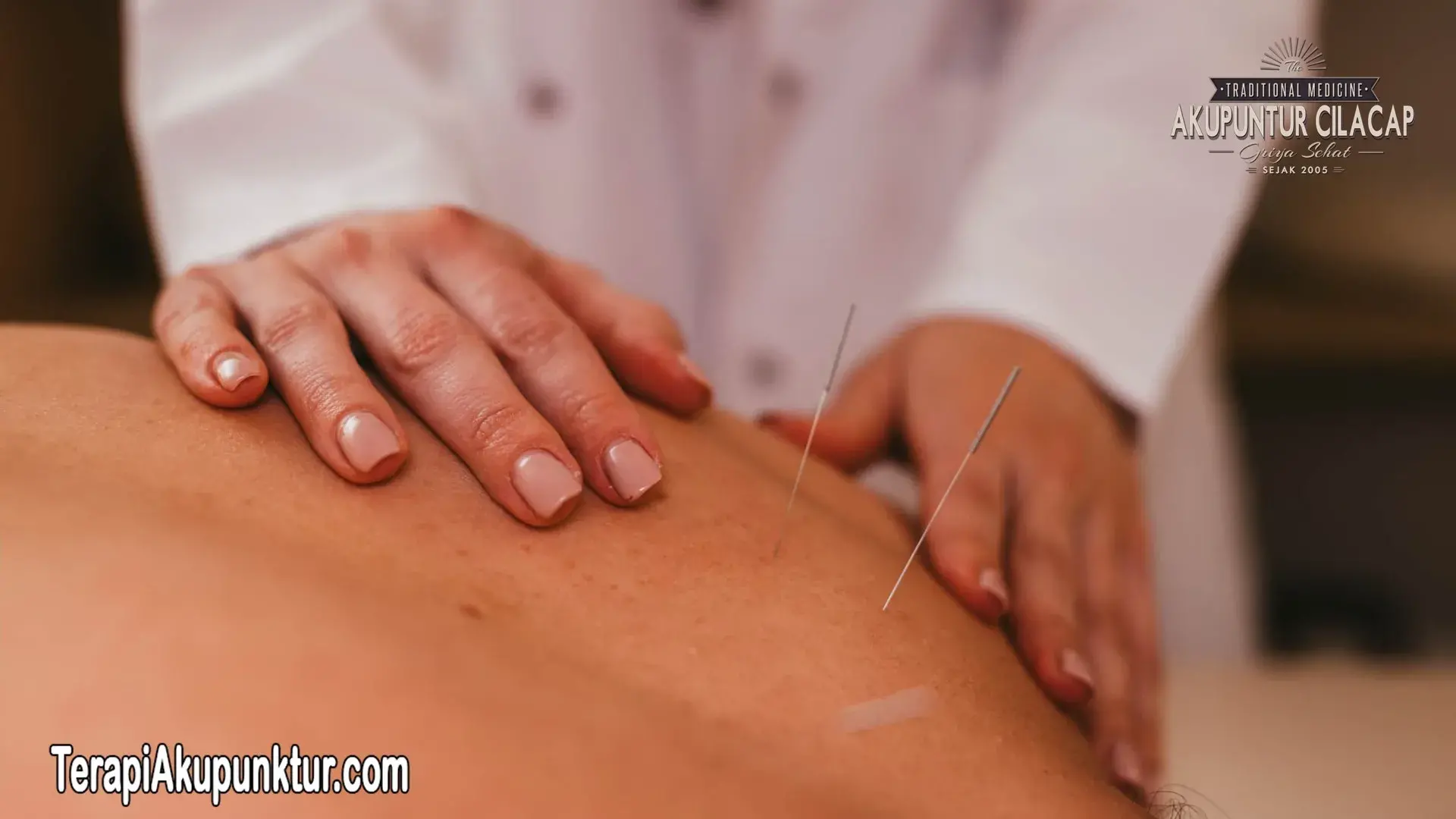 Terapi Akupunktur Panggilan di Jakarta Timur
