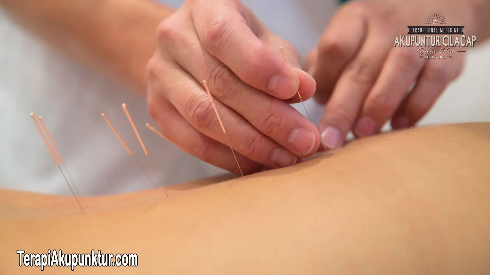 Terapi Akupunktur untuk Kesuburan