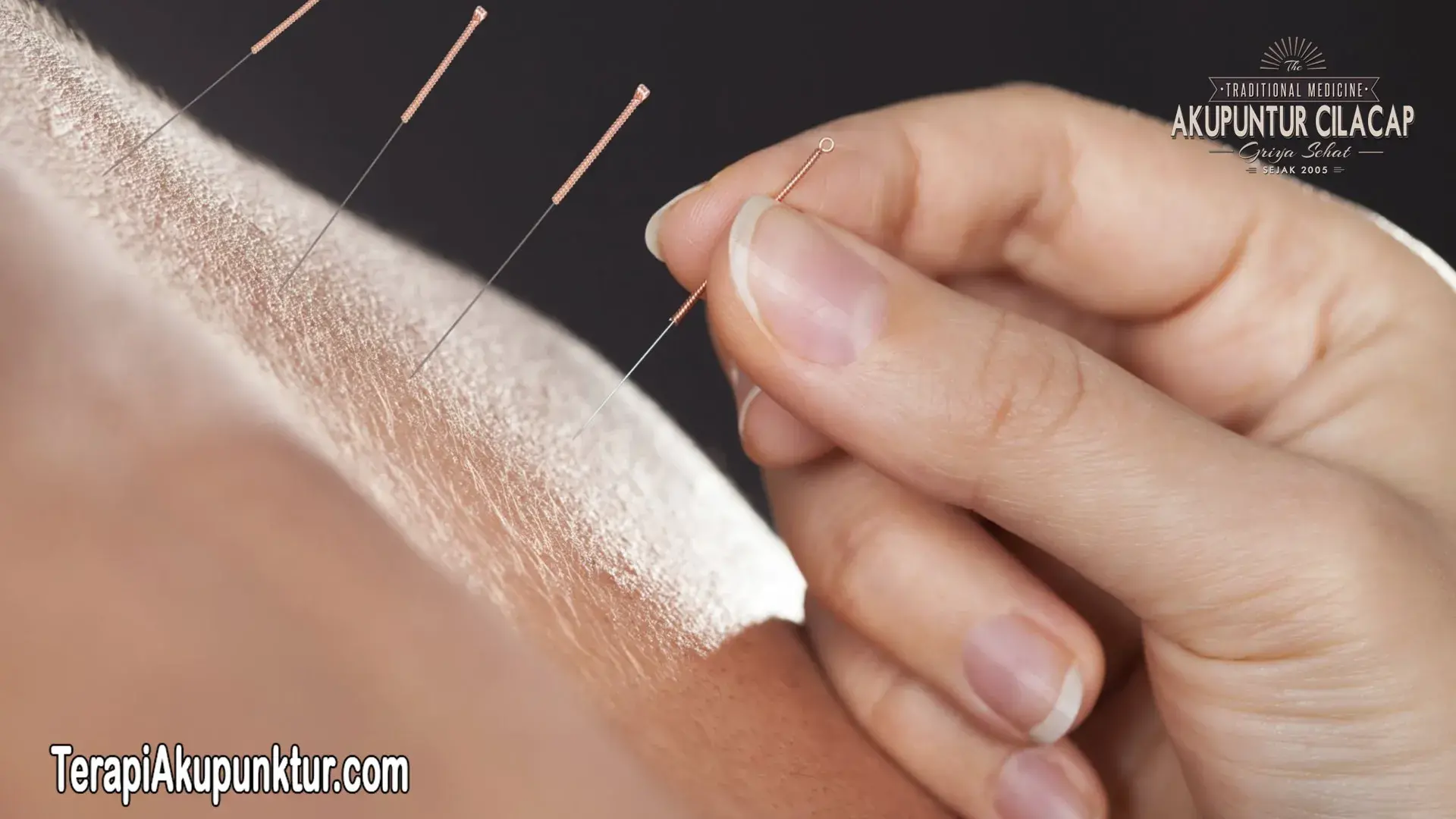 akupunktur untuk nyeri bahu